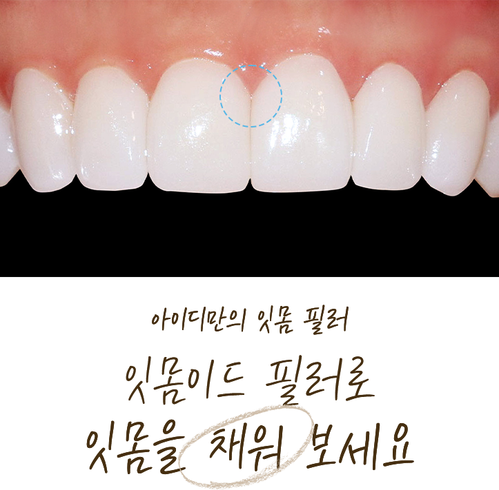 아이디만의 잇몸 필러 잇몸이드 필러로 잇몸을 채워보세요