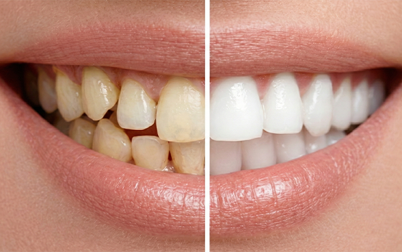 라미네이트, 마이트