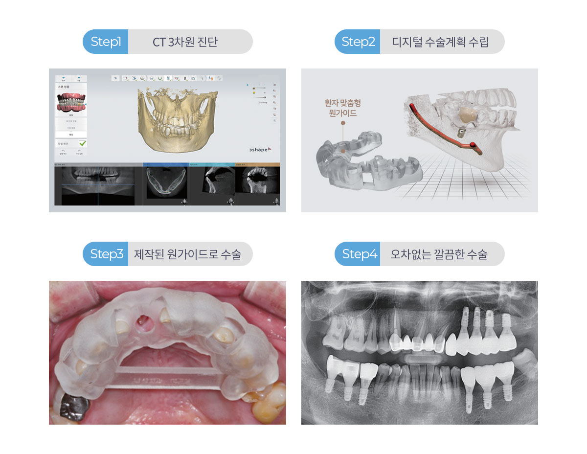 네비게이션 임플란트 STEP