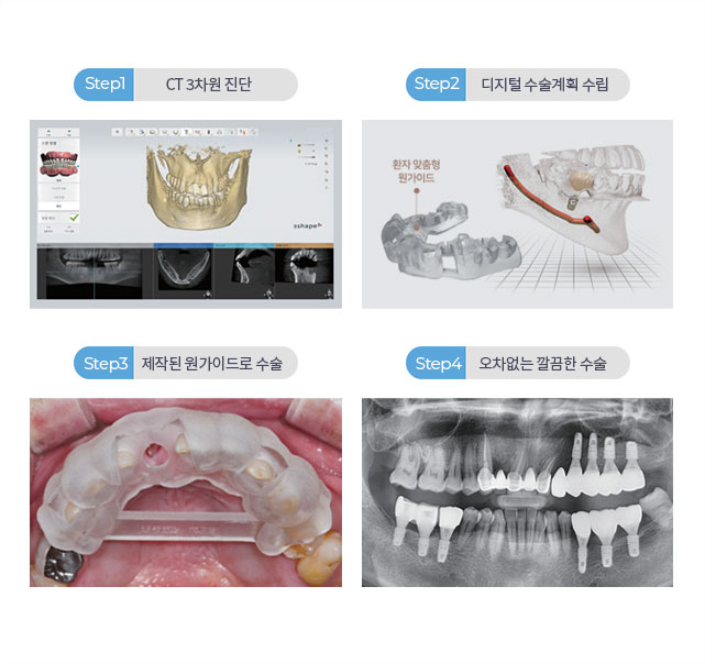 네비게이션 임플란트 STEP